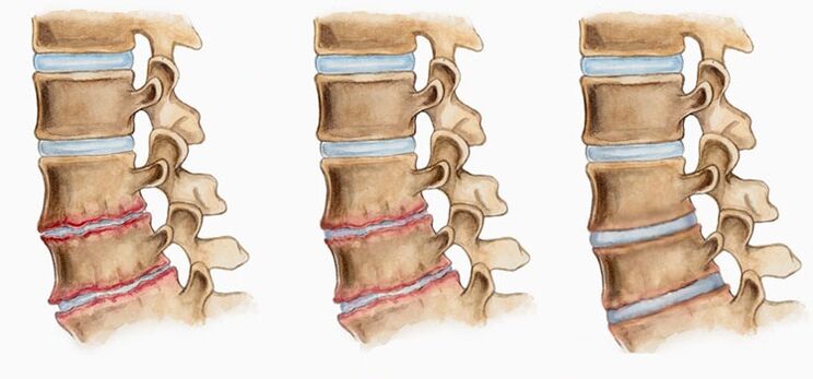 Deformatioun vun den intervertebrale Scheiwen an der Osteochondrose kann Réckschmerzen verursaachen
