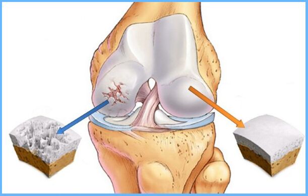 Arthrosis vum Knéi Gelenk