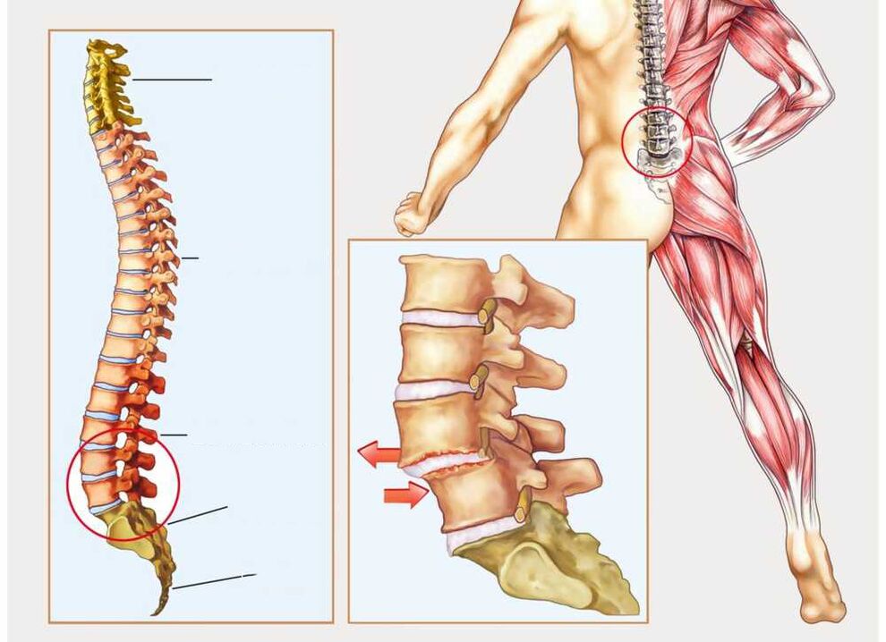 gesond a krank Wirbelsäule
