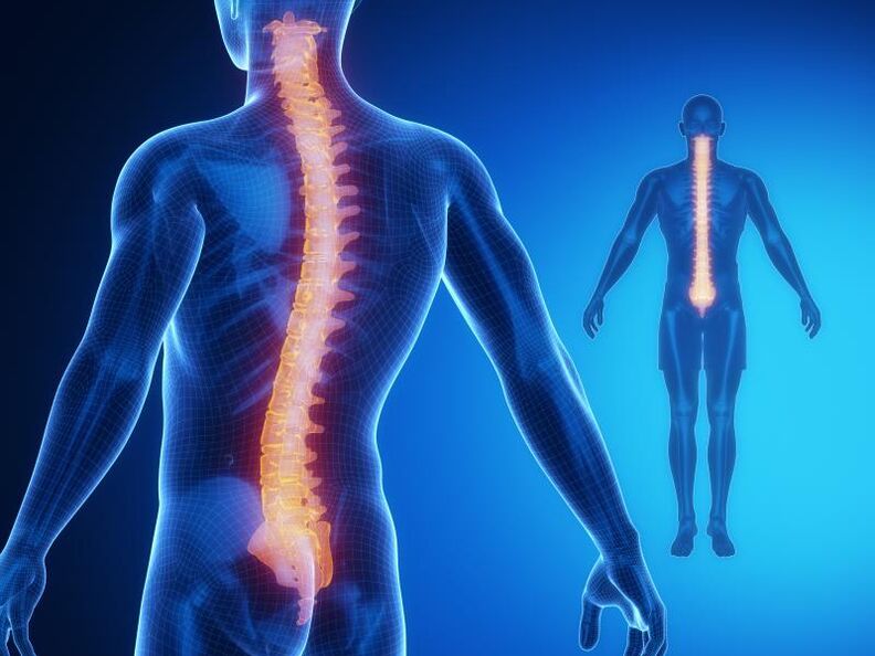 Osteochondrose vun der Wirbelsäule, erfuerdert komplex Behandlung