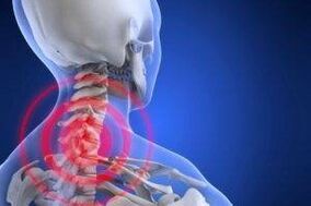 Péng am Hals mat Osteochondrose
