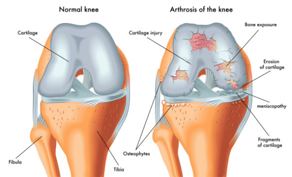 Normal Gelenk a betraff vun Arthrosis