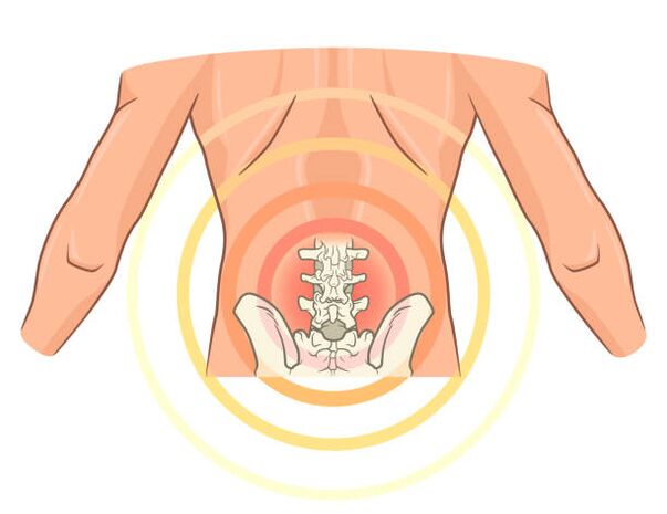 Osteochondrose vun der Lendenwirbelsäule